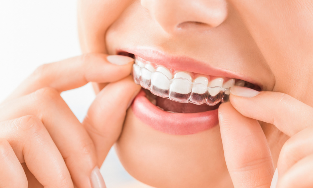 What are invisible braces and why should you get them?